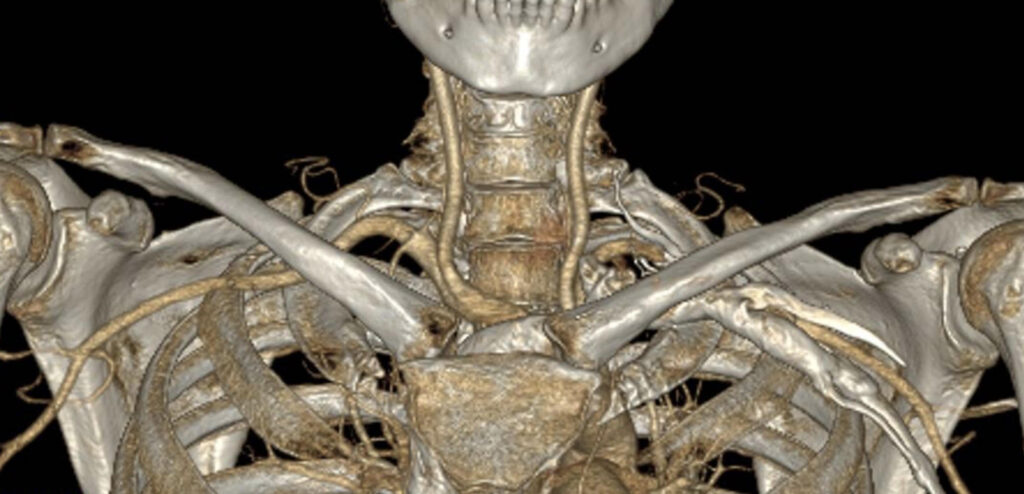 Thoracic-Outlet-Syndrom diagnostizieren: Untersuchungen, Funktionstests und wichtige Differentialdiagnosen